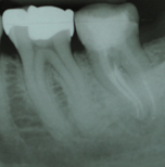 Zahnarzt Gabriel, Trier - Endodontie