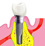 Zahnarzt Gabriel, Trier - Implantologie